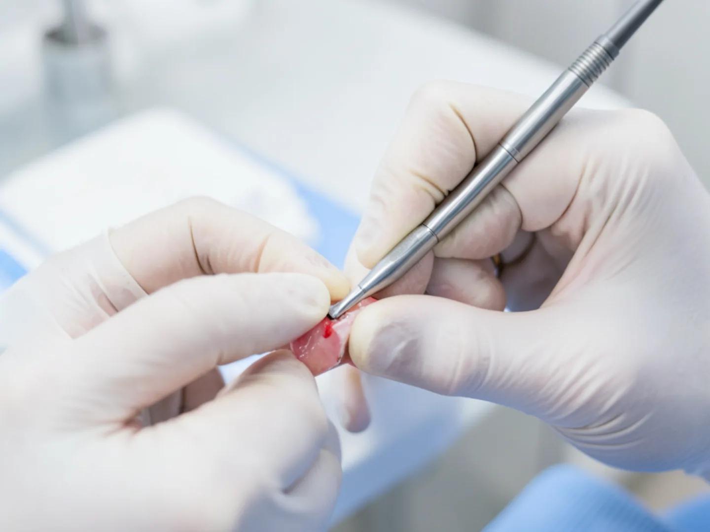 Dentist sculpting tooth-colored composite resin to rebuild fractured incisor