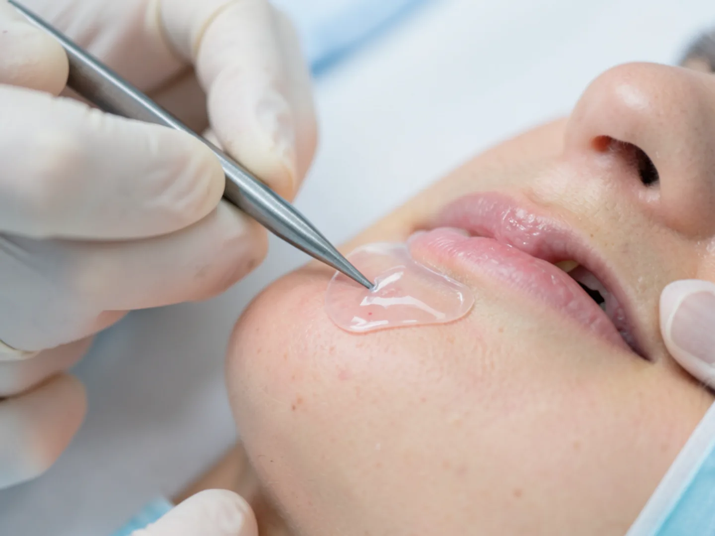 Cosmetic dentist fitting custom porcelain veneer with try-in paste