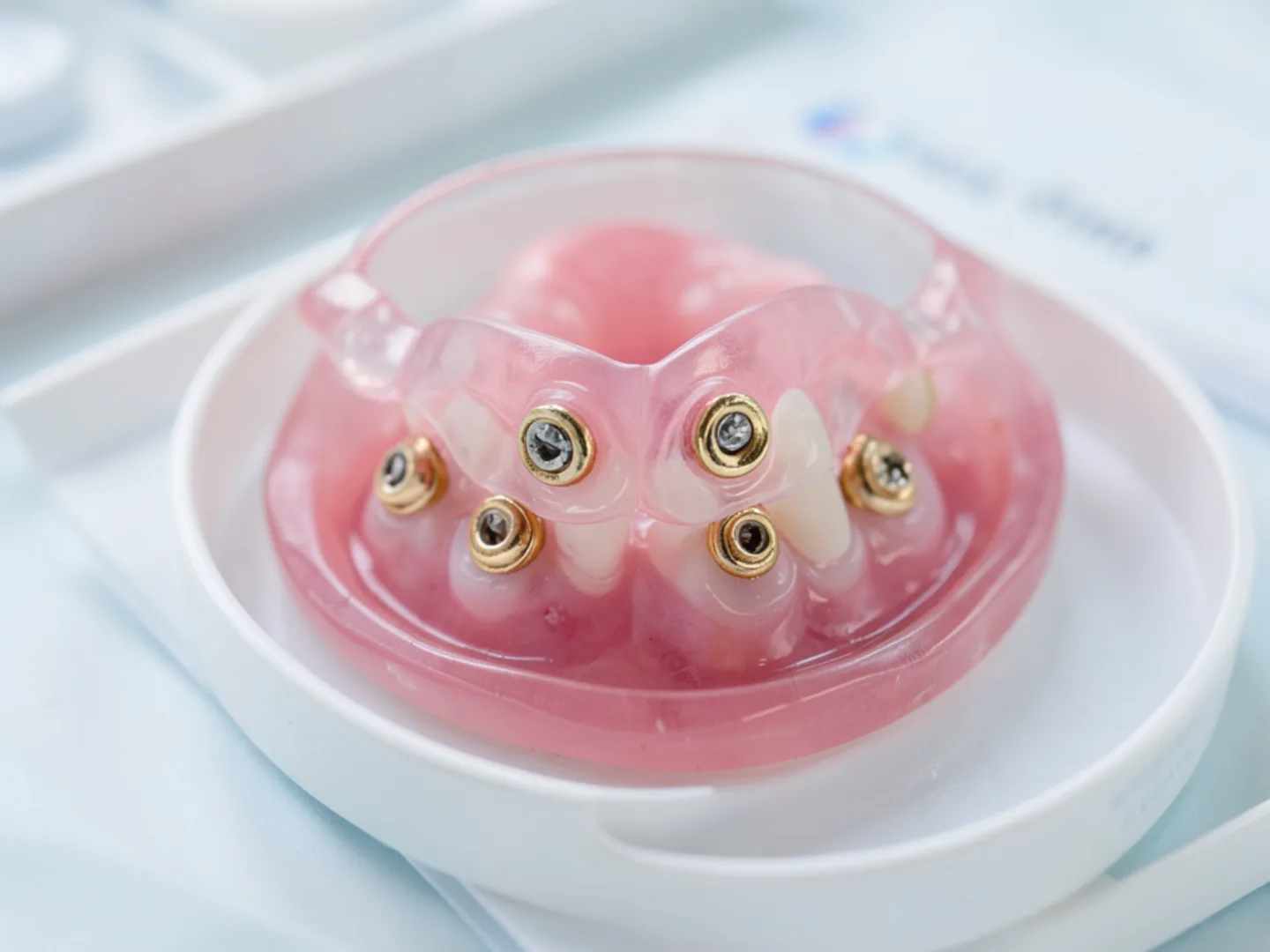 Underside of implant-retained overdenture showing gold locator snap attachments